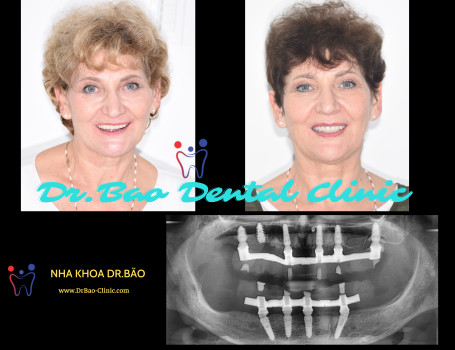 Cấy ghép răng implant