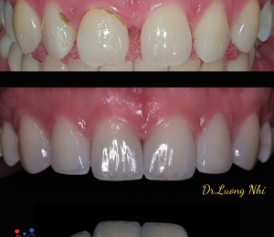 Phục hình thẩm mỹ