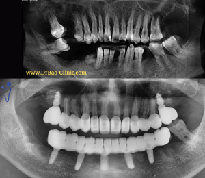 Dental – Implant Da Nang