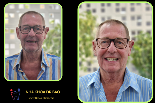 I nearly forget my smile Dr.Bao – A happy smile after dental treatment in Da Nang City